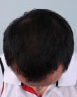 After Hair Transplant&nbsp;Front